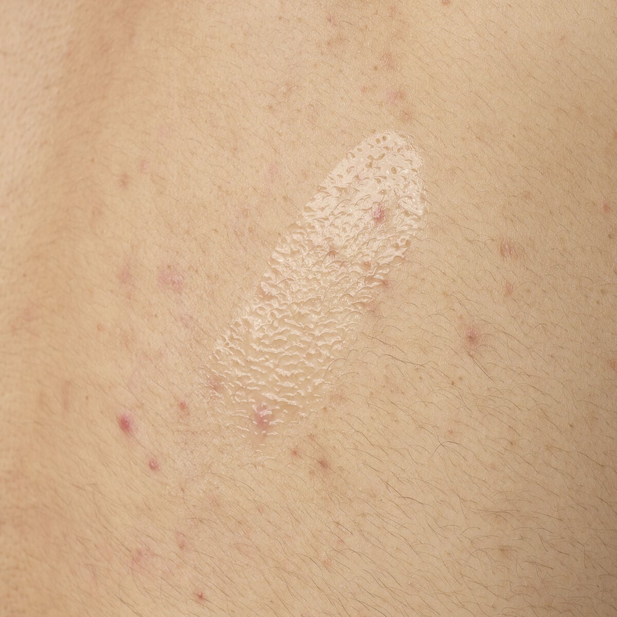 salicylic-acid-0-5-body-serum-o4 ORD-salicylic-acid-05-body-240ml-application.jpg