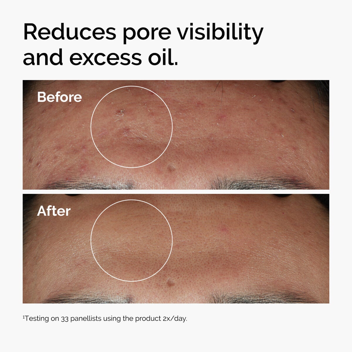 niacinamide-10-zinc-1-i3 ord-niacinamide-zinc-blemish-serum-before-after-pores.jpg