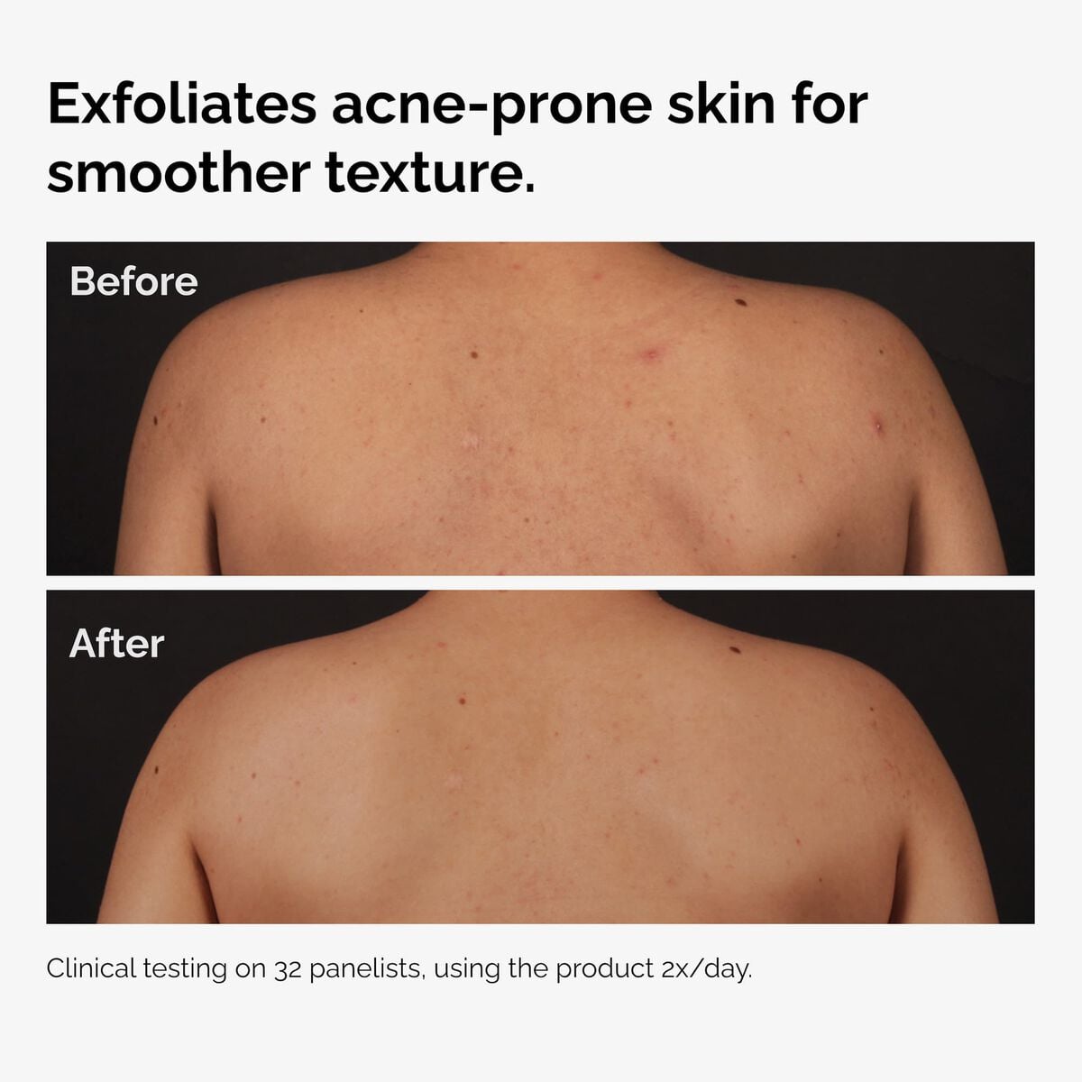 salicylic-acid-0-5-body-serum-o4 ord-salicylic-acid-body-serum-before-after-graphic-NA.jpg