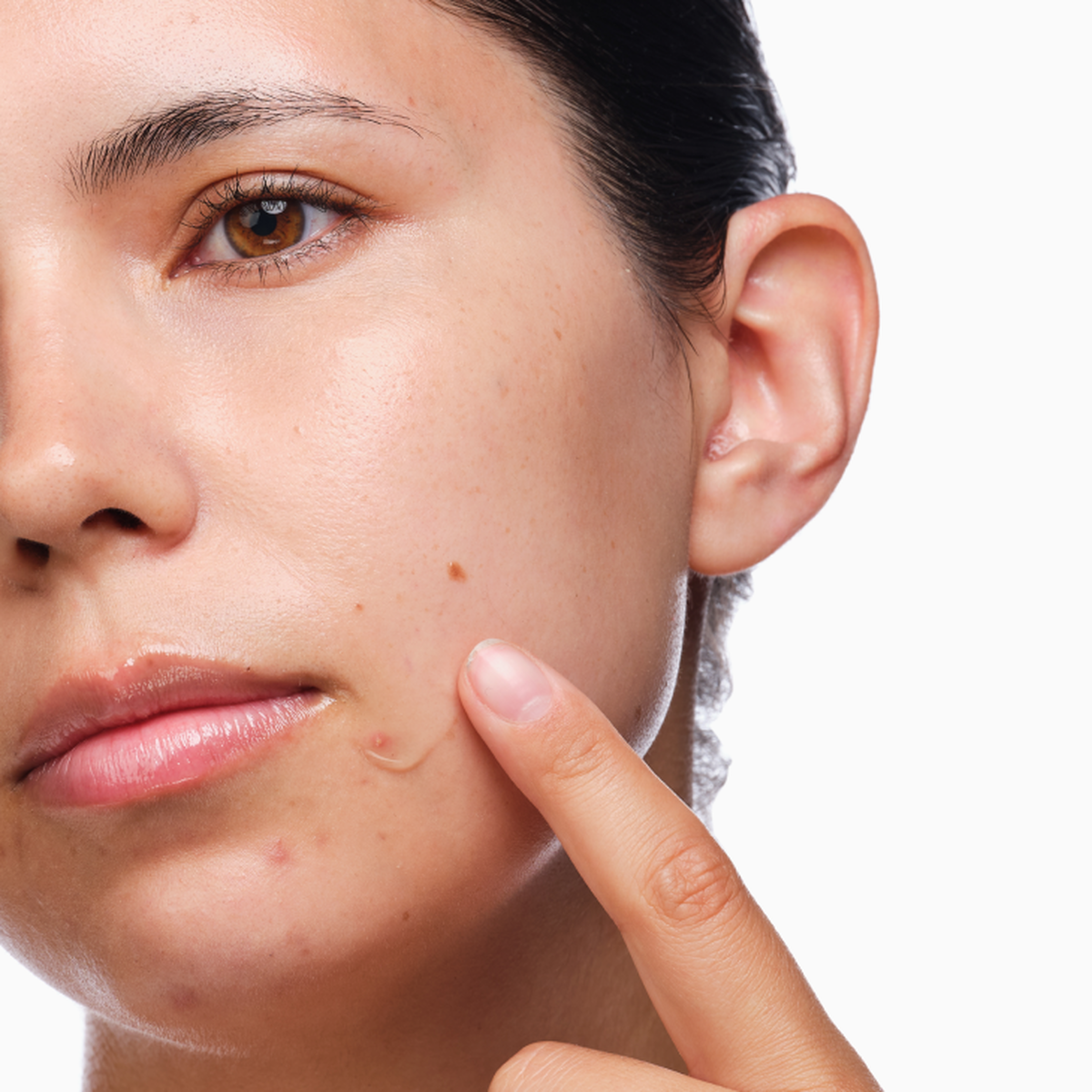 the-acne-set-c8 rdn-the-acne-set-application.png